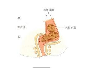 FDA 批准 Fenix System 器械用于大便失禁