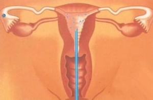 FDA 加强经阴道器械的临床要求