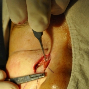 全厚皮片移植（FTSG）是修复外科缺损的重要技术