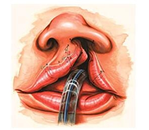 新办法：改良直线松解术治疗单侧唇裂