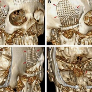一种新型颅底重建技术——「反鸥翼」钛网塑形重建技术