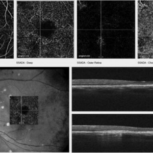 血管造影光学相干断层扫描让诊断更快更精确