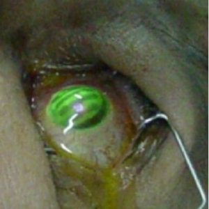 角膜交联术治疗圆锥角膜远期预后安全有效