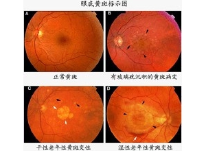 隐形杀手：双磷酸盐或可诱发湿性年龄相关性黄斑变性