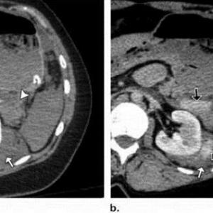 腹盆腔钝性创伤：血管损伤的 CT 扫描方案及技术