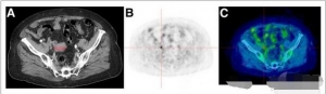 18F-FDG PET/CT 可有效诊断子宫内膜癌
