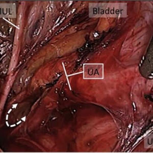 腹腔镜子宫切除术在解剖学起源上考虑子宫动脉血管的结扎