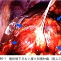 腹腔镜网膜肿瘤切除术